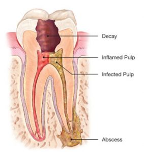 Anatomy of a diseased and inflamed tooth's root; root canal