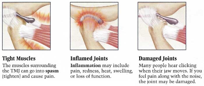 Causes of TMJ problems (TMD)