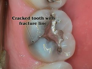 Cracked tooth