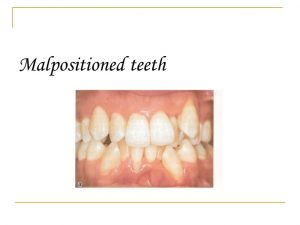 Malpositioned Teeth